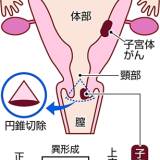 【金沢医科大】子宮頸がん予防ＨＰＶワクチン　総合的研究で有効性実証　1500人調査、研究チーム「国内初」・・未接種者の２％にがんに進むリスクが高い中高度の異常が検出された一方、接種者には検出されなかった