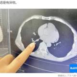 【国際】就寝中の男性の鼻からゴキブリが侵入、気管内に3日留まり口臭や咳（中国）